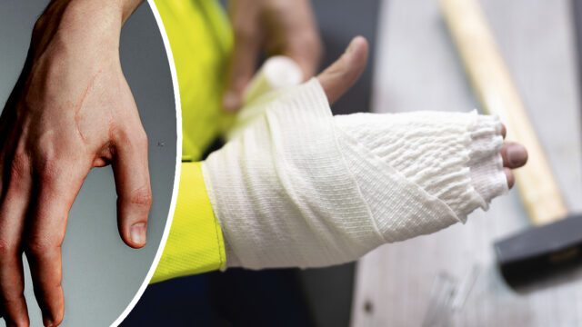 Hand med ärr och person som lindar sin hand