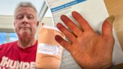 Brännskadad av tätningsmedlet HydraCrystal