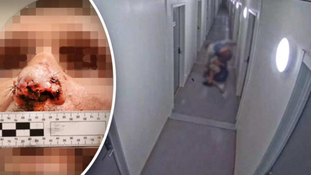 Blev biten i näsan – hämnades brutalt
