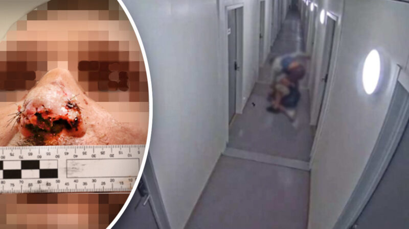 Blev biten i näsan – hämnades brutalt